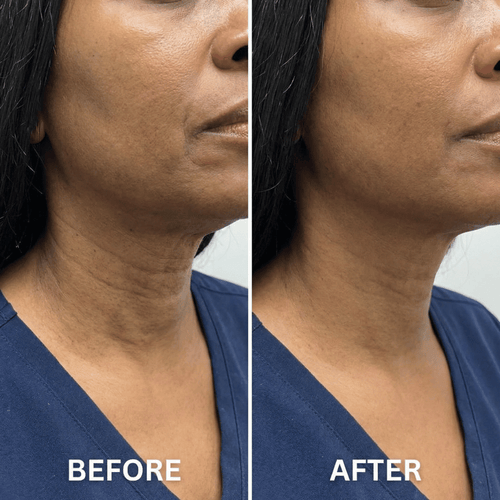 Anti-Cellulite Massage Oil