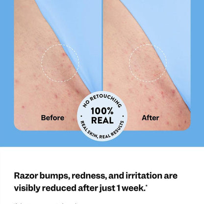 Ingrown Hair Treatment